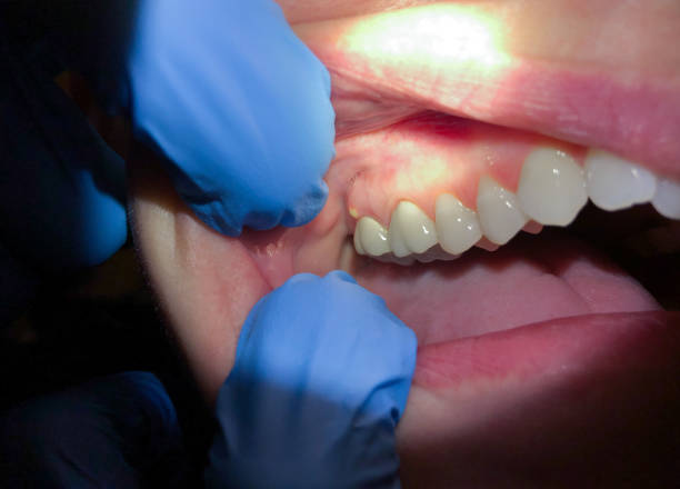 Best Emergency Wisdom Teeth Removal in Felida, WA